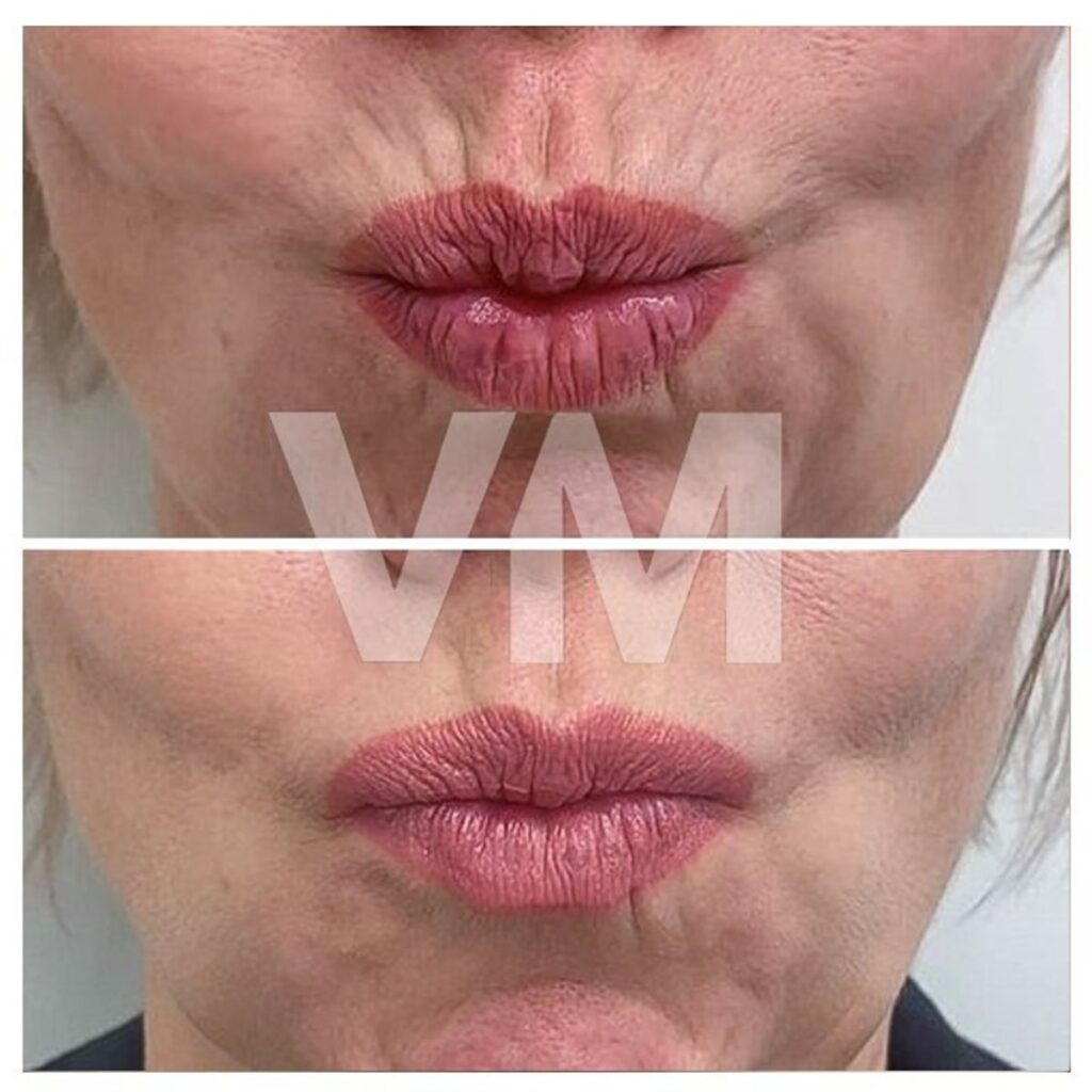 botox huulet helsinki ennen jalkeen