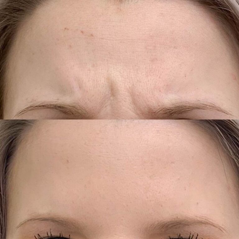 baby-botox-kokemuksia