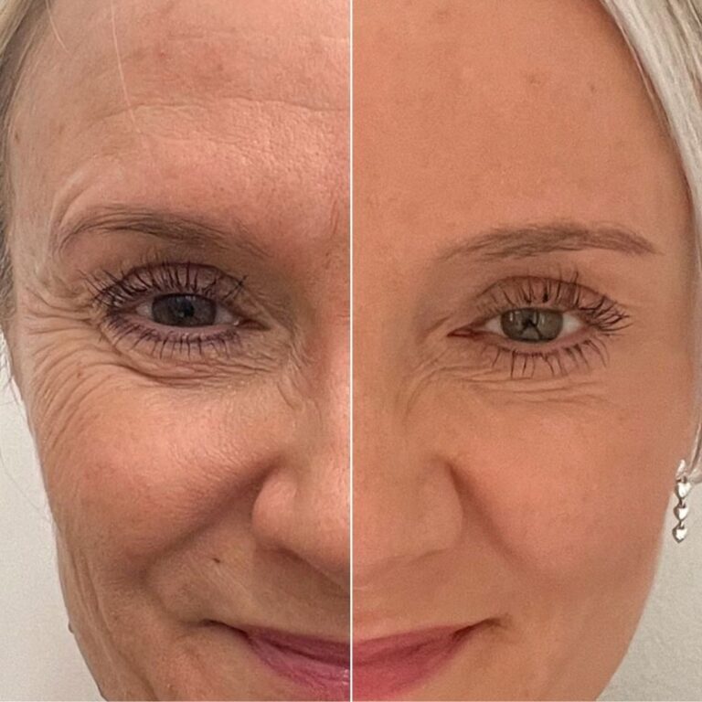 botox-harakanvarpaat-ennen-jalkeen