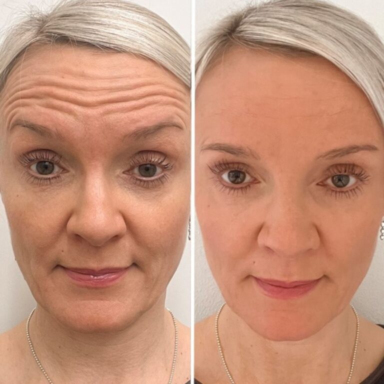 botox-helsinki-ennen-jalkeen-ville-mannisto-kokemuksia
