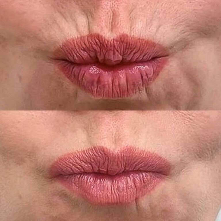 botox-huulet-kokemuksia-ville-mannisto