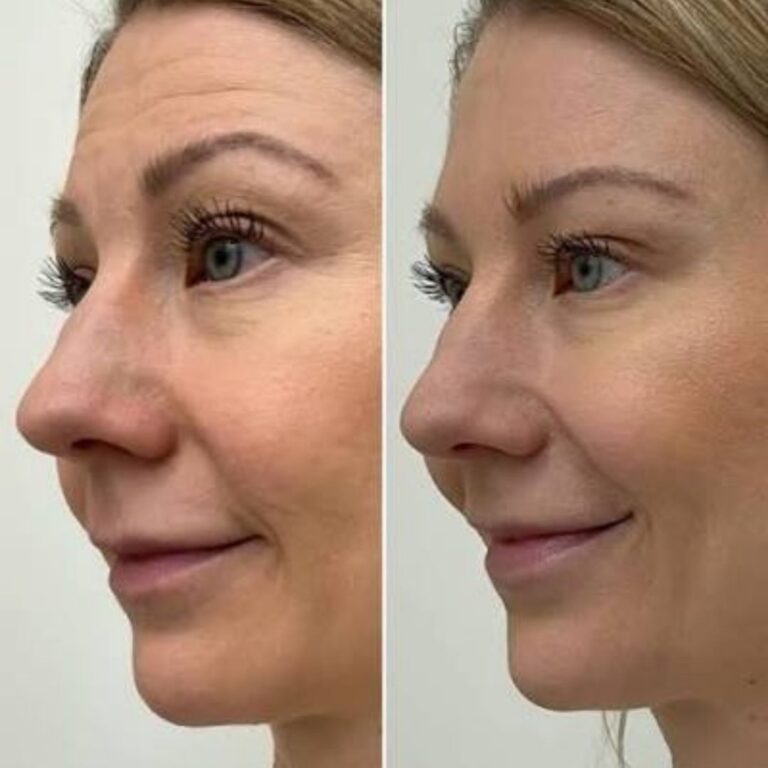botox-kokemuksia-3