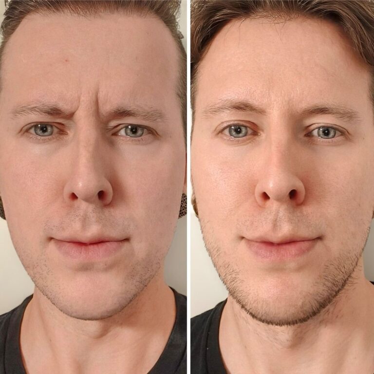 botox-kokemuksia-helsinki