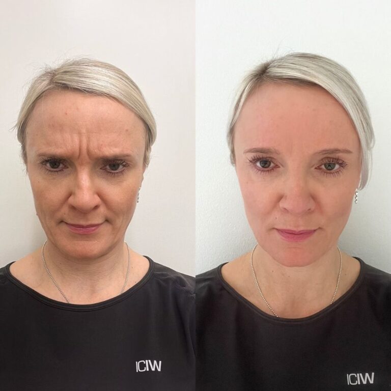 botox-otsa-kokemuksia