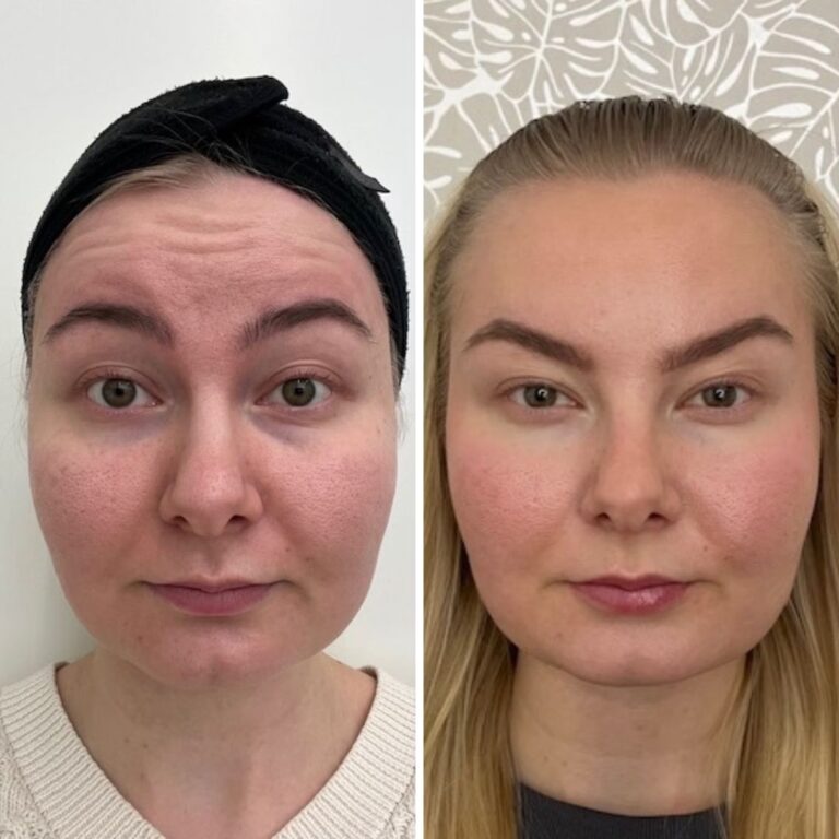 botox-otsaan-3-kokemuksia