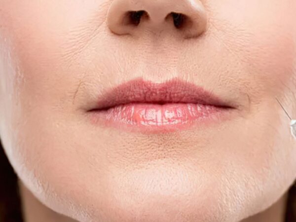 Botox & suupielet – mitä hoito tekee ja milloin se toimii?