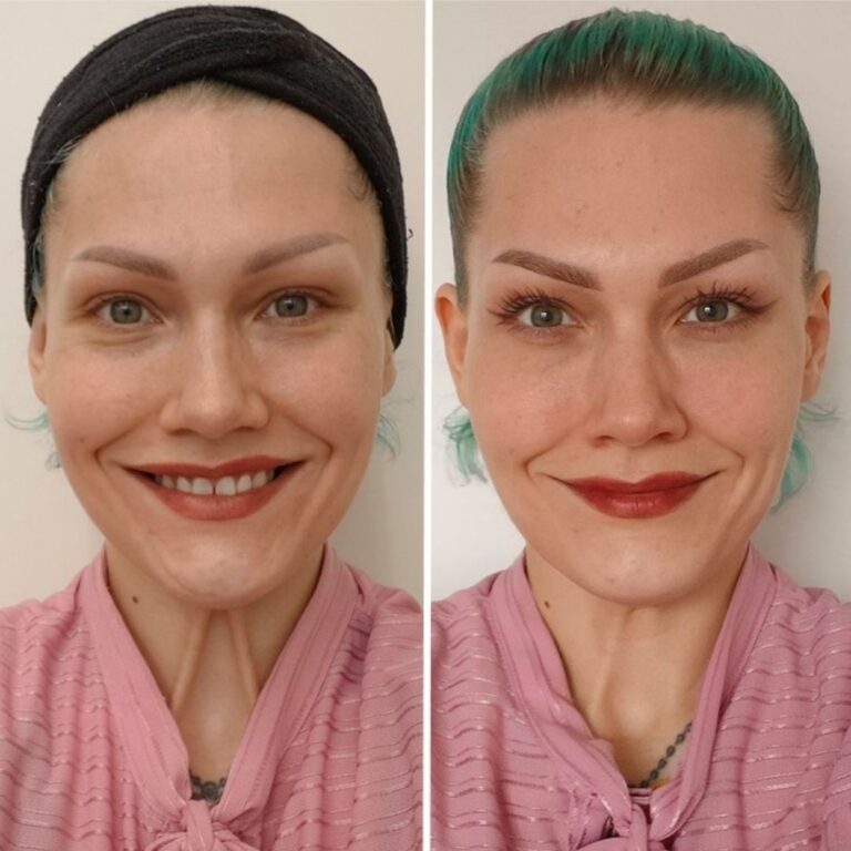 luonnollinen-botox-helsinki-kokemuksia