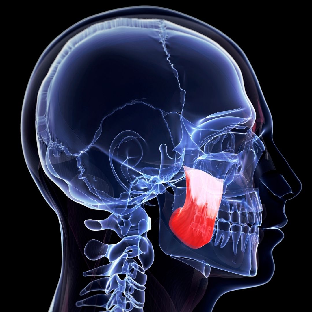 Masseter-lihas eli purentalihas bruksismissa