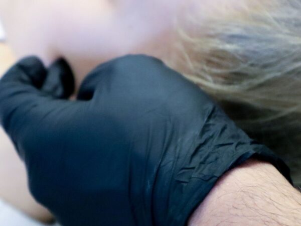 Masseter botox: mitä purentalihasten botuliinihoito tekee?